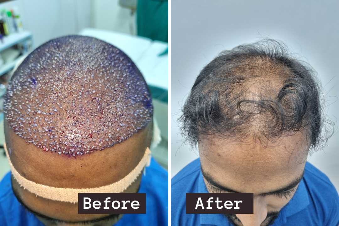 Hair Treatment in Bhubaneswar