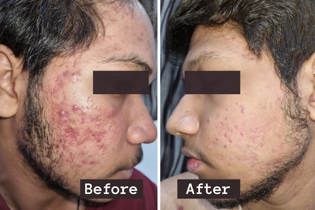 Skin treatment before after