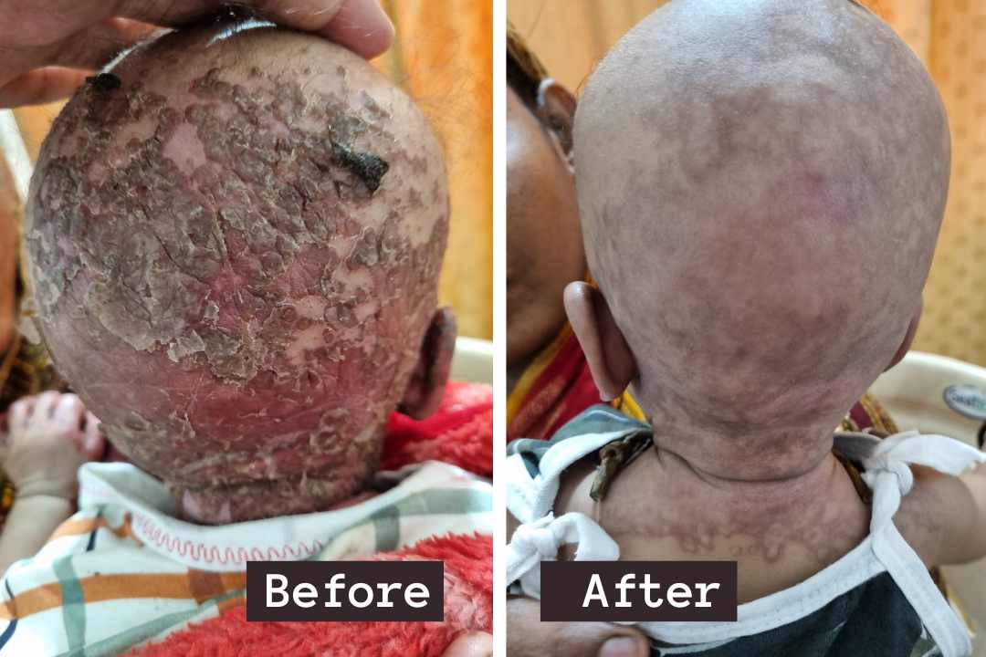 skin treatment before after