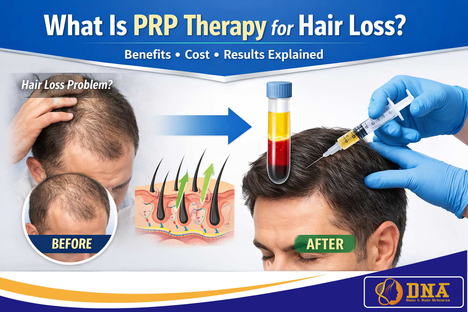 What Is PRP Therapy for Hair Loss Benefits, Cost & Results