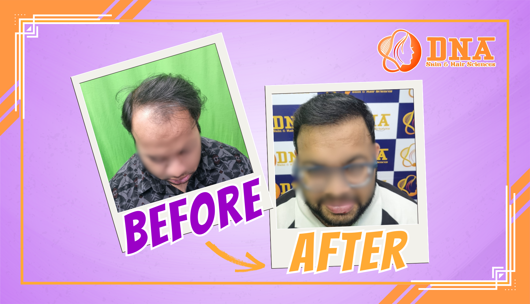 Hair Transplant Clinic in Bhubaneswar